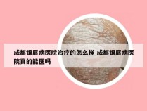 成都银屑病医院治疗的怎么样 成都银屑病医院真的能医吗