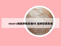 munro微脓肿银屑病HE 脓肿型银屑病