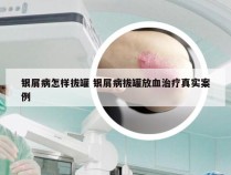 银屑病怎样拔罐 银屑病拔罐放血治疗真实案例