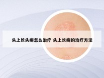 头上长头癣怎么治疗 头上长癣的治疗方法