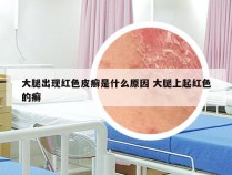 大腿出现红色皮癣是什么原因 大腿上起红色的癣