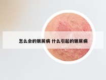 怎么会的银屑病 什么引起的银屑病