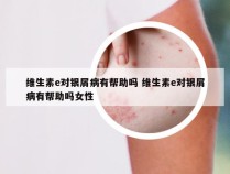 维生素e对银屑病有帮助吗 维生素e对银屑病有帮助吗女性