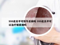 999皮炎平可擦牛皮癣吗 999皮炎平可以治疗银屑病吗