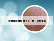 腋窝红癣图片 腋下长一块一块的像癣