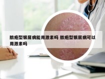 脓疱型银屑病能用激素吗 脓疱型银屑病可以用激素吗