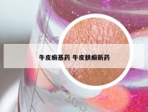 牛皮癣基药 牛皮肤癣新药