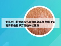 他扎罗汀倍他米松乳膏效果怎么样 他扎罗汀乳膏和他扎罗汀倍他米松区别