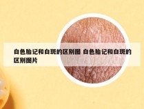 白色胎记和白斑的区别图 白色胎记和白斑的区别图片