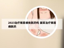 2023治疗银屑病有新药吗 国家治疗银屑病新药