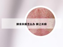 脚肯长癣怎么办 脚上长癣