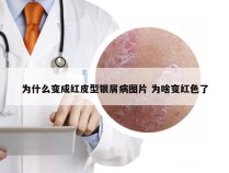 为什么变成红皮型银屑病图片 为啥变红色了