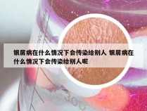 银屑病在什么情况下会传染给别人 银屑病在什么情况下会传染给别人呢