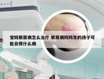 宝妈银屑病怎么治疗 银屑病妈妈生的孩子可能会得什么病