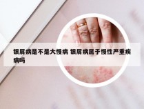 银屑病是不是大慢病 银屑病属于慢性严重疾病吗