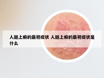 人腿上癣的最初症状 人腿上癣的最初症状是什么