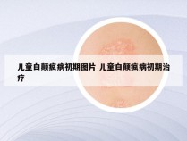 儿童白颠疯病初期图片 儿童白颠疯病初期治疗