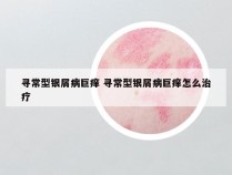 寻常型银屑病巨痒 寻常型银屑病巨痒怎么治疗