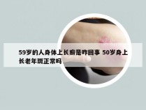 59岁的人身体上长癣是咋回事 50岁身上长老年斑正常吗