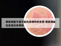 银屑病是不是不能吃高嘌呤的食物 银屑病能吃高蛋白食物吗