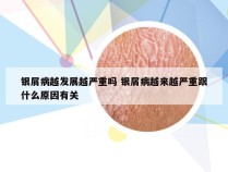 银屑病越发展越严重吗 银屑病越来越严重跟什么原因有关