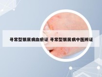 寻常型银屑病血瘀证 寻常型银屑病中医辨证