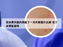 交水费大腿内彻起了一大片癣是什么癣 交了水费能退吗