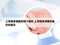 上海银屑病医院哪个最好 上海银屑病看的最好的医生