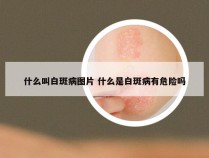 什么叫白斑病图片 什么是白斑病有危险吗