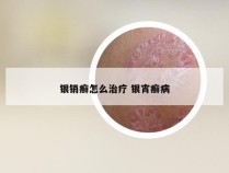 银销癣怎么治疗 银宵癣病