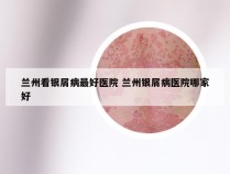 兰州看银屑病最好医院 兰州银屑病医院哪家好