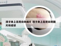 孩子身上出现白斑图片 孩子身上出现白斑图片和症状