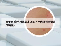 癣手肘 癣手肘关节上上长了个大硬包需要治疗吗图片