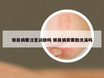 银屑病要注意润肤吗 银屑病需要勤洗澡吗