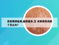 皮肤瘙痒起癣,越抓越多,怎 皮肤痒抓成癣了怎么办?