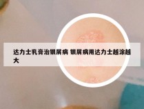 达力士乳膏治银屑病 银屑病用达力士越涂越大