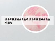 青少年银屑病会自愈吗 青少年银屑病会自愈吗图片