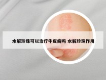 水解珍珠可以治疗牛皮癣吗 水解珍珠作用