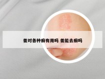 姜对各种癣有用吗 姜能去癣吗