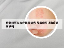 羟氯喹可以治疗银屑病吗 羟氯喹可以治疗银屑病吗