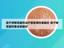 南宁到哪家医院治疗银屑病效果最好 南宁哪家医院看皮肤最好