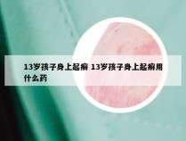 13岁孩子身上起癣 13岁孩子身上起癣用什么药