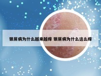 银屑病为什么越来越痒 银屑病为什么这么痒