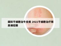 国际干细胞治牛皮癣 2021干细胞治疗银屑病招募