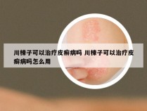 川楝子可以治疗皮癣病吗 川楝子可以治疗皮癣病吗怎么用