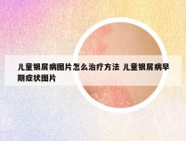 儿童银屑病图片怎么治疗方法 儿童银屑病早期症状图片