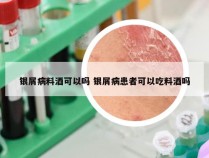 银屑病料酒可以吗 银屑病患者可以吃料酒吗