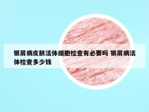 银屑病皮肤活体细胞检查有必要吗 银屑病活体检查多少钱