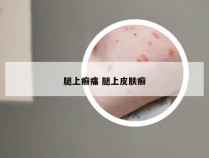 腿上癣痛 腿上皮肤癣