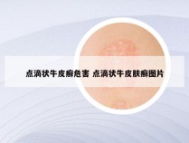 点滴状牛皮癣危害 点滴状牛皮肤癣图片